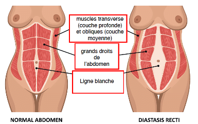 Diastase des grands droits de l'abdomen