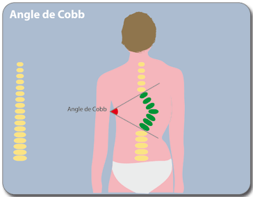 Angle de Cobb